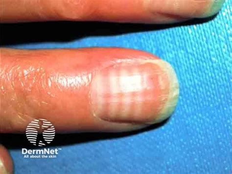define leukonychia|DermNet® .
